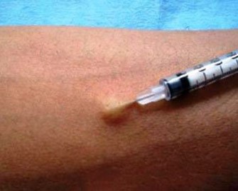 verem-esqine-pul-qazananlar-mantu-sinaginin-sirrleri-