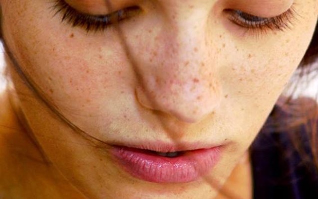 hamilelikden-qalan-lekelerden-qurtulmagin-yolu-