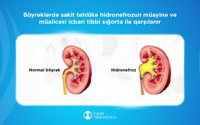 boyreklerde-hidronefrozun-muayine-ve-mualicesi-icbari-tibbi-sigorta-ile-qarsilanir