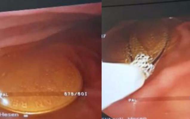 bakida-usagin-medesinden-20-qepik-cixarildi