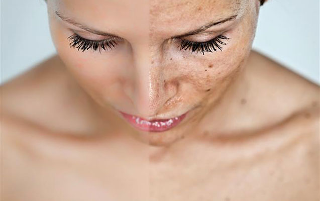 bunlari-edin-uzunuzdeki-lekelerden-qurtulun