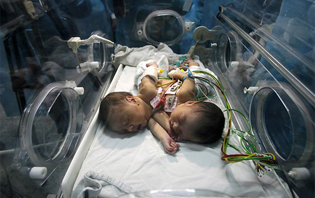 bir-ureyi-olan-siam-ekizleri-doguldu