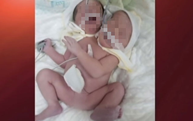 ukraynada-ikibasli-usaq-dunyaya-geldi