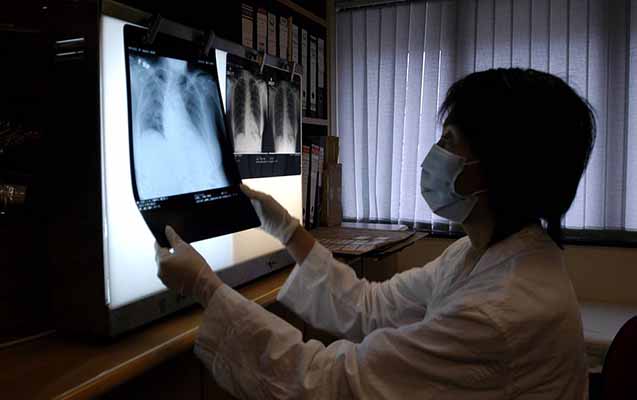 cinde-44-nefer-namelum-pnevmoniyaya-yoluxub