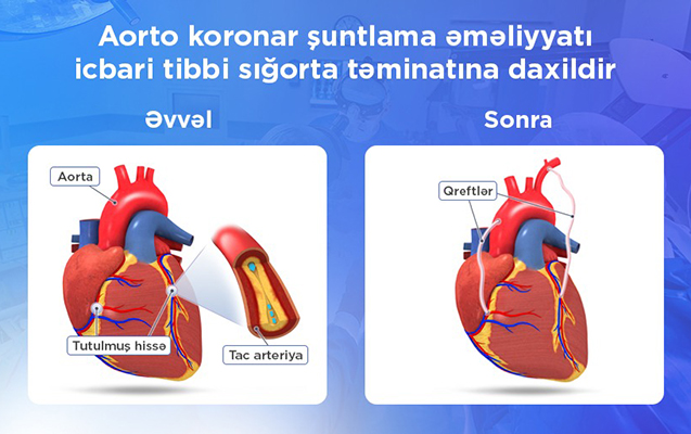 aorto-koronar-suntlama-emeliyyati-icbari-tibbi-sigorta-ile-qarsilanir