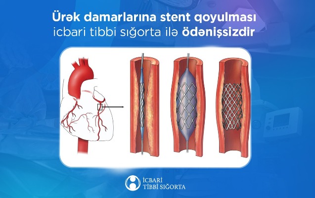 urek-damarlarina-stent-qoyulmasi-its-ile-odenissizdir