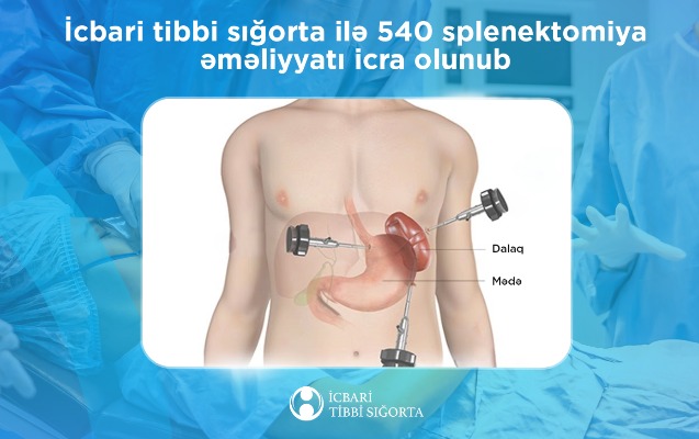 its-ile-540-splenektomiya-emeliyyati-icra-olunub