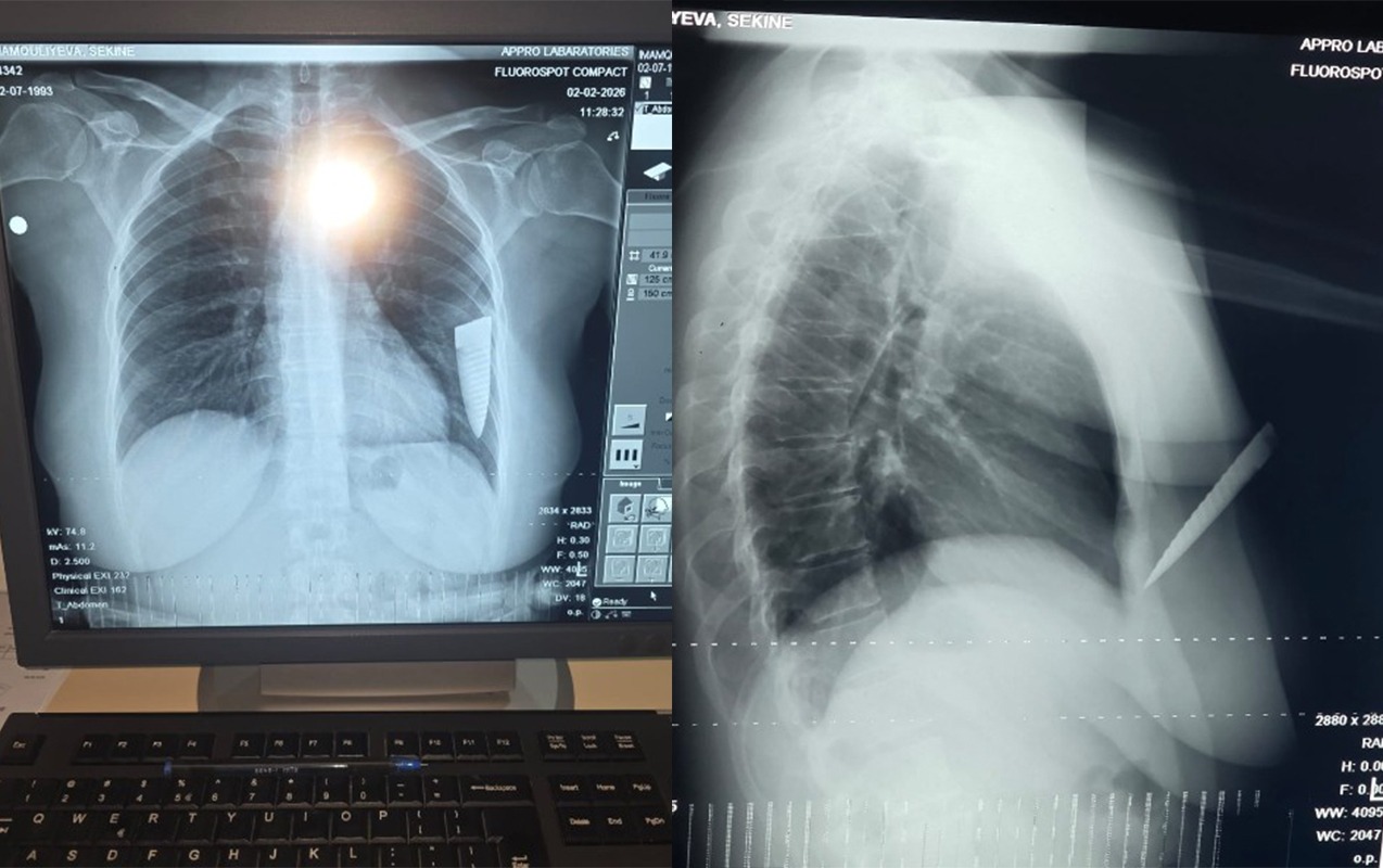 toydan-cixarken-bicaqlandi