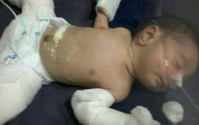 ana-betninde-usaq-ekiz-tayini-udub